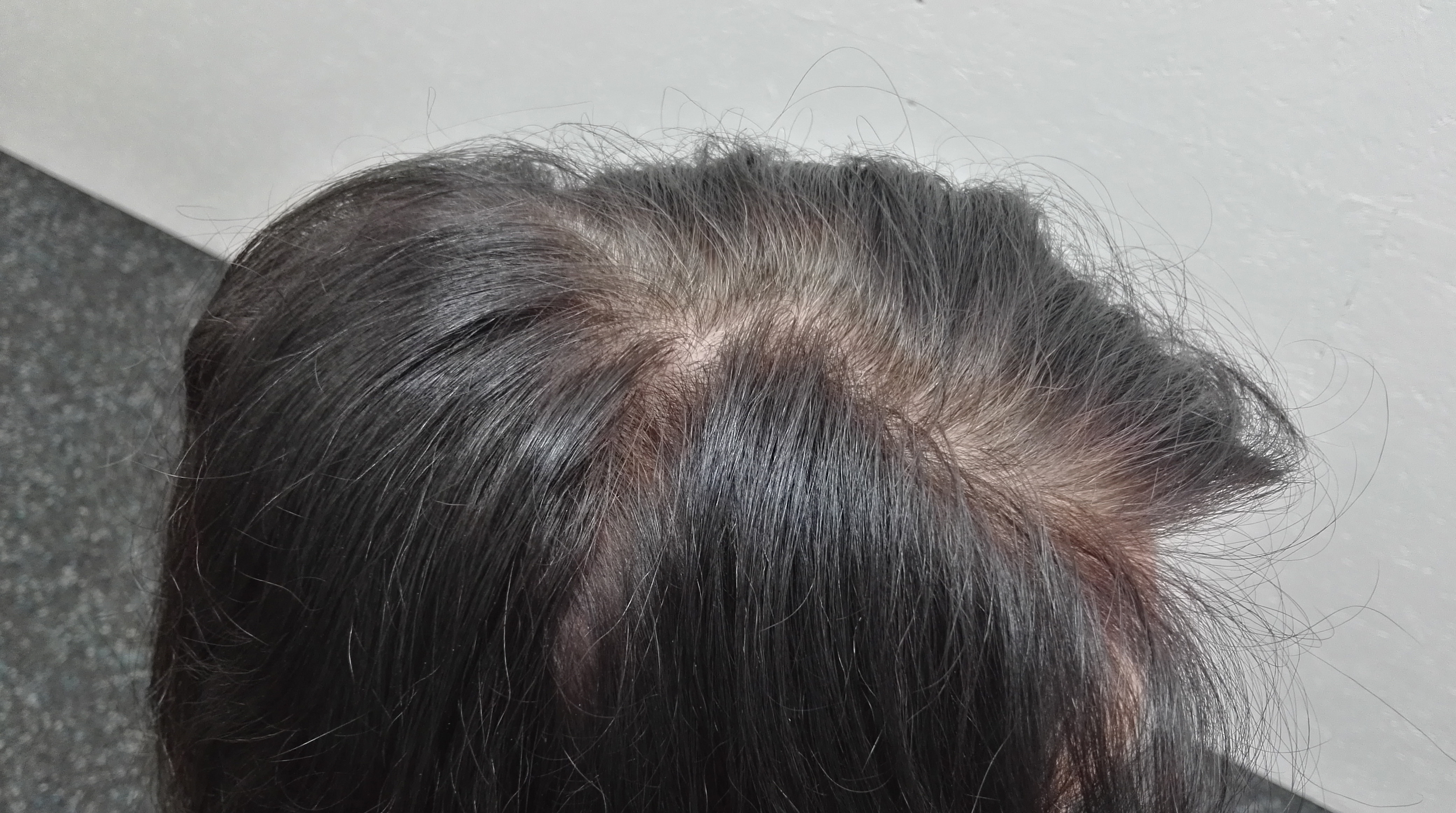 Einen guten Zentimeter ist das dunkel gefärbte Haar rausgewwachsen. am Scheitel ist der graue Ansatz sichtbar.